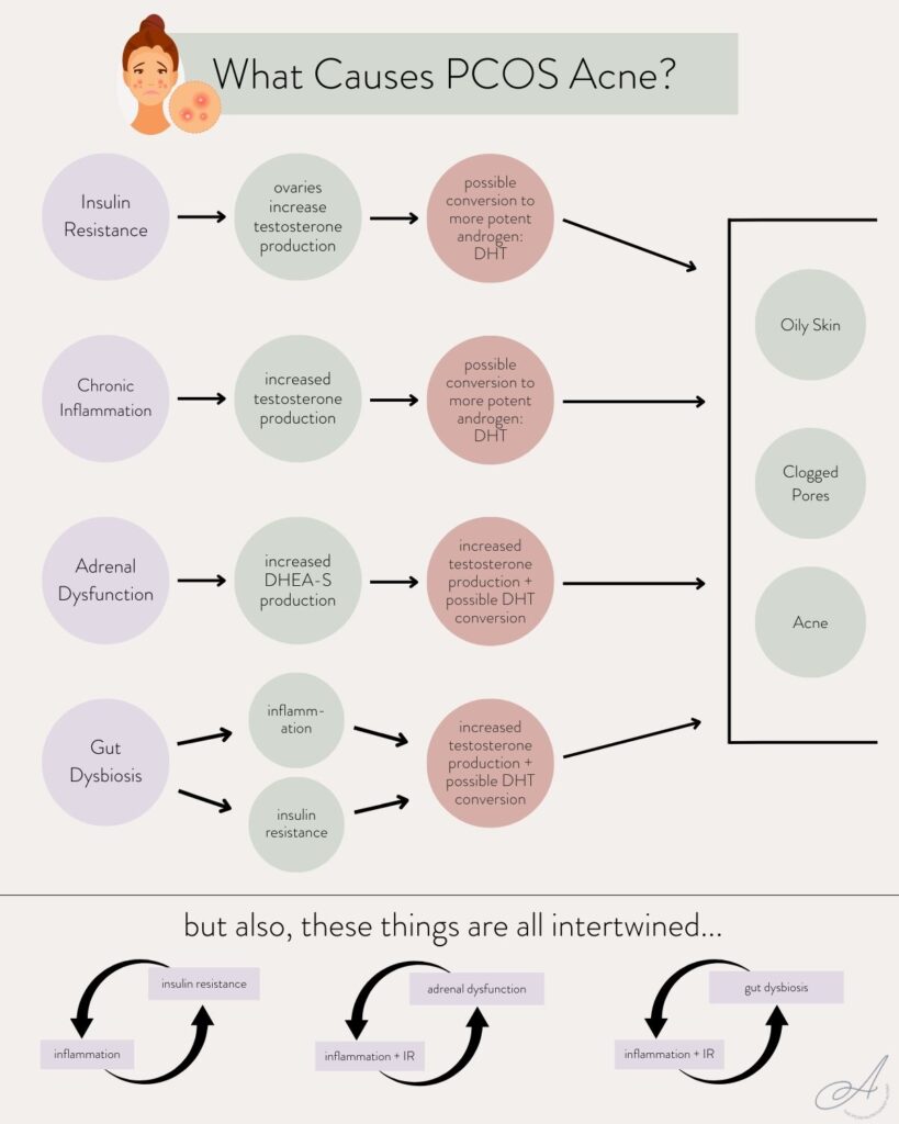 infographic on the causes of pcos acne.